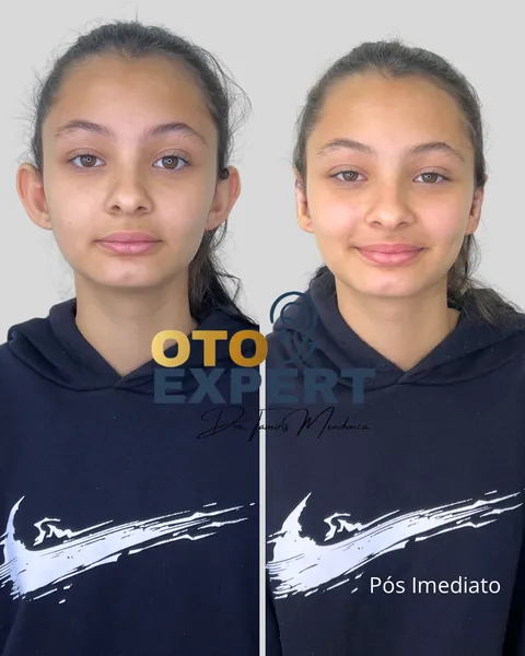 Antes e depois de otomodelação, paciente 1