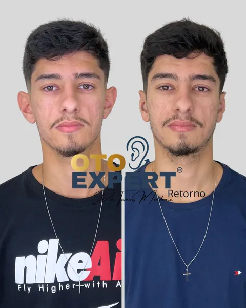 Antes e depois de otomodelação, paciente 2