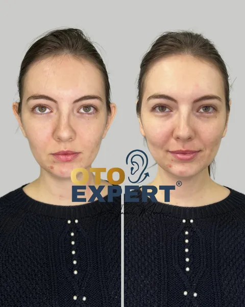Antes e depois de otomodelação, paciente 3