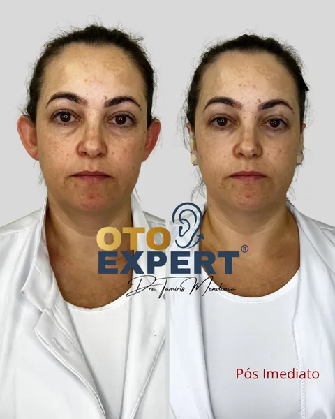 Antes e depois de otomodelação, paciente 4