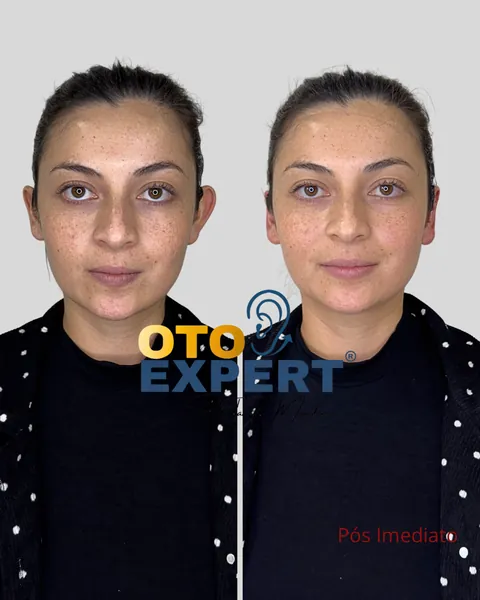 Antes e depois de otomodelação, paciente 5
