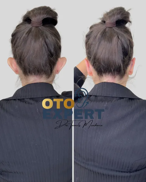 Antes e depois de otomodelação, paciente 6