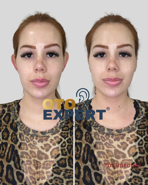 Antes e depois de otomodelação, paciente 7